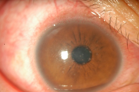 結膜充血を伴う前眼部の細隙灯顕微鏡写真 / Slit-lamp photo: conjunctival hyperemia