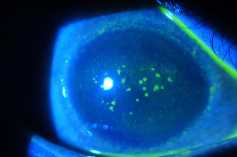 フルオレセイン染色で点状に染まる角膜病変（コバルトブルー照明） / Punctate fluorescein staining of corneal lesions under cobalt-blue light